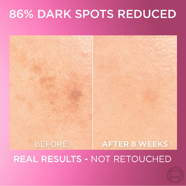 Glycolic Bright Serum with 8% [Melasyl ™ + Glycolic Acid + Niacinamide] face serum for Dark Spots & Brightening - Before & After